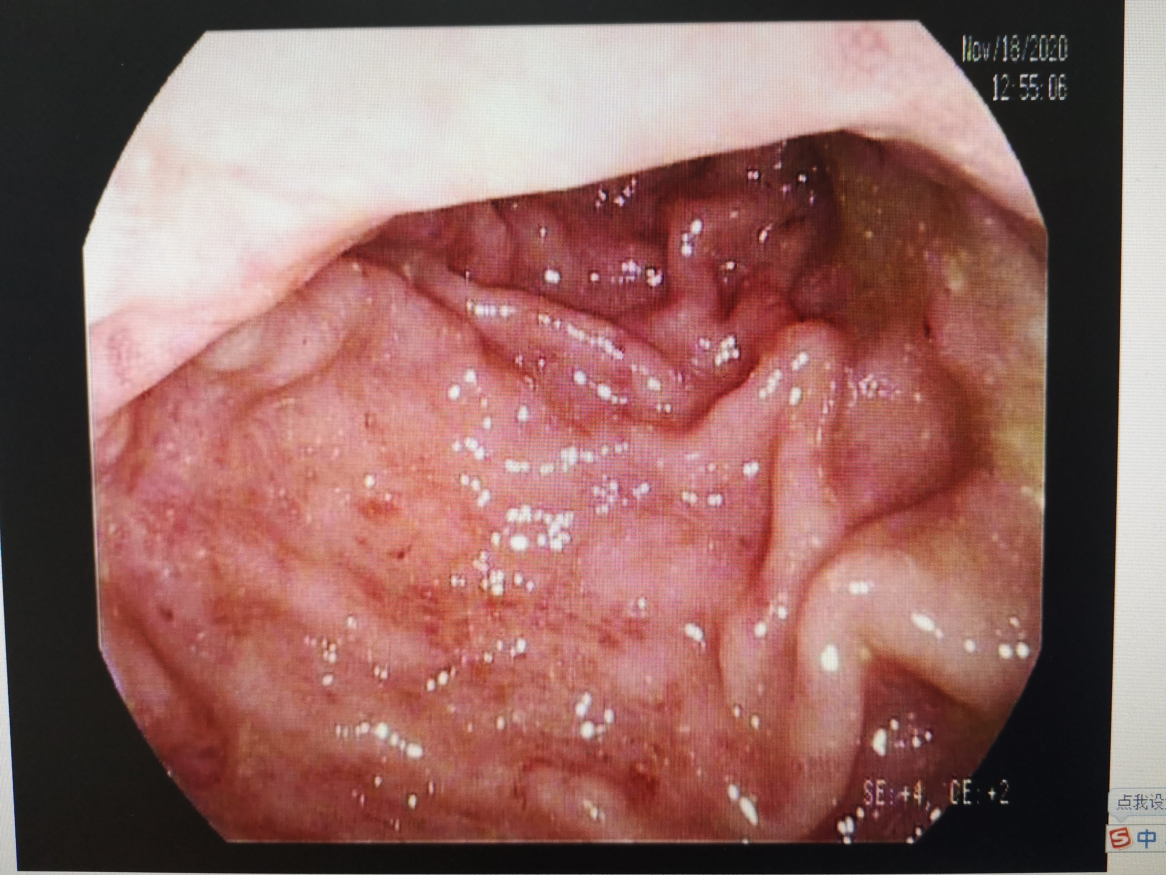 结肠炎照片图图片