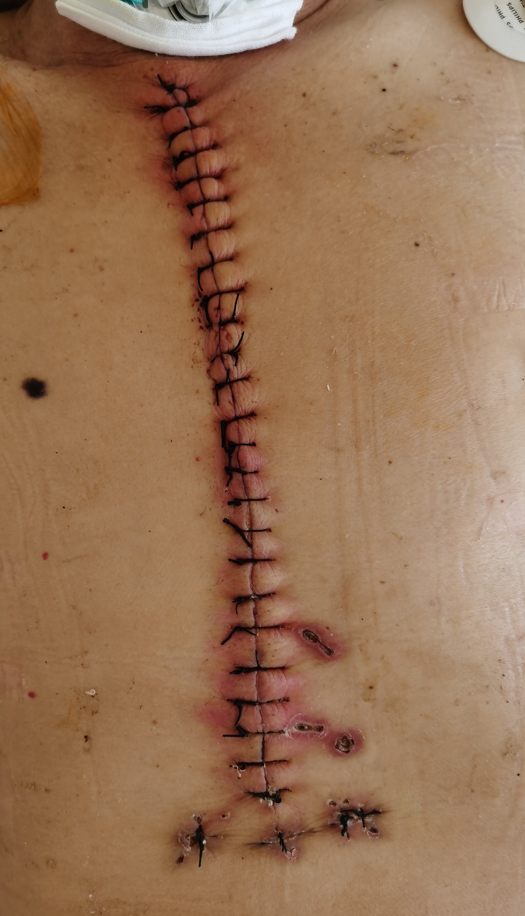 做了心脏手术的伤口图图片