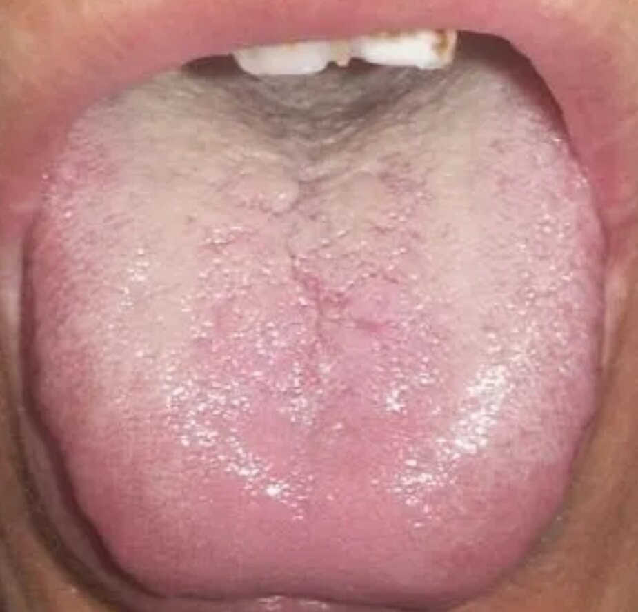 舌根是我们的肾,舌底苔代表了肾阴,肾阴必须由肾阳的温化,才演化成
