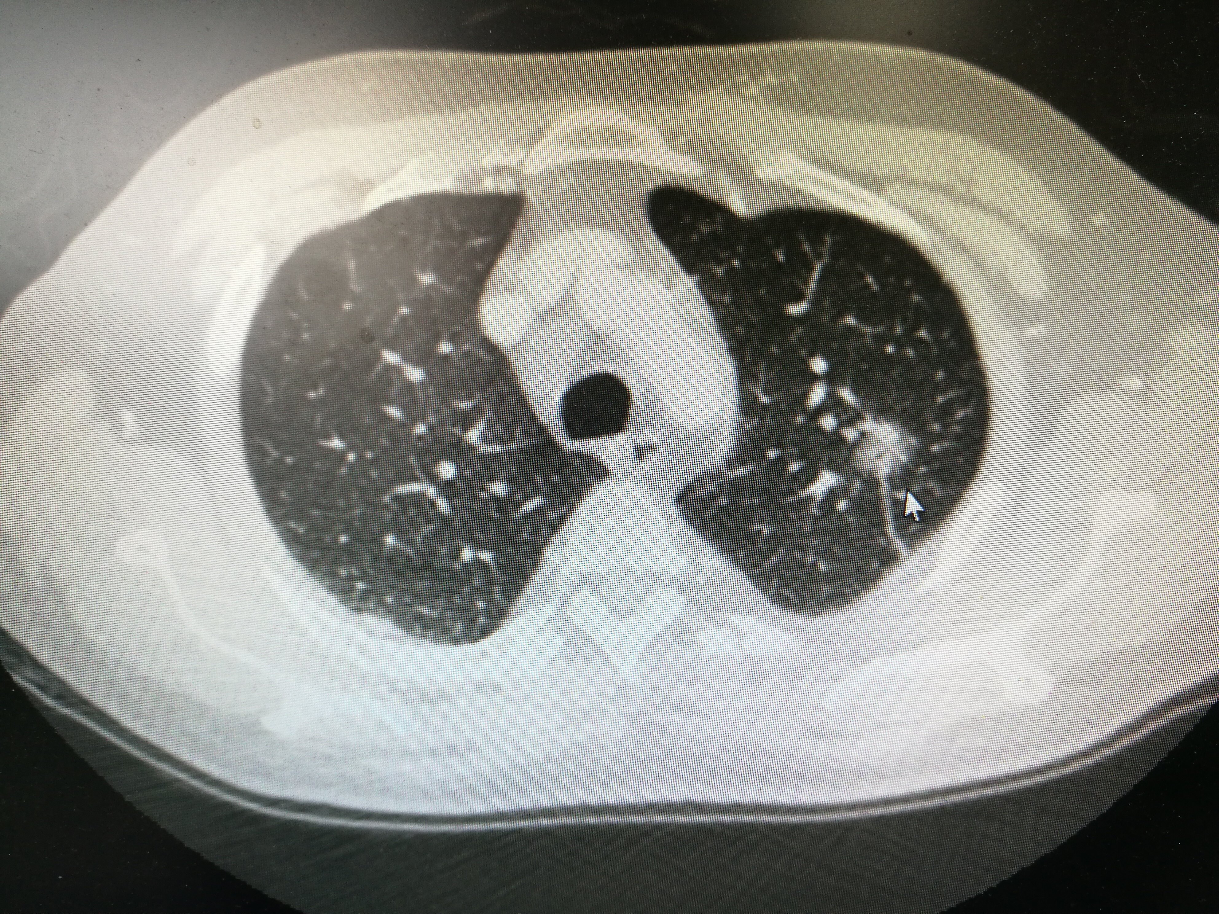 肺部结节 肺部结节