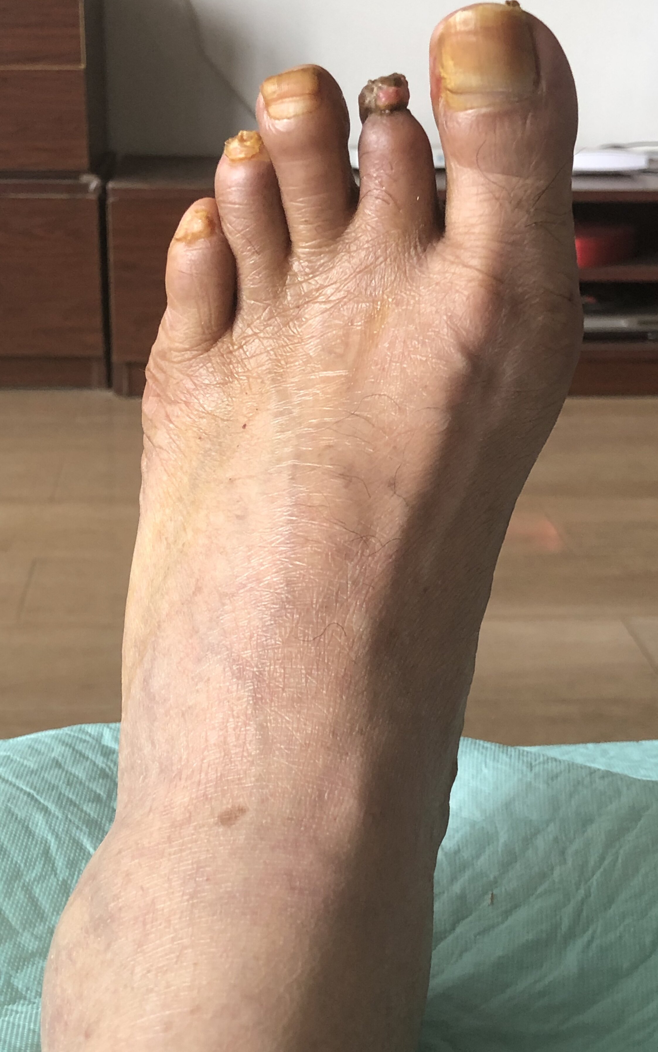 缺血性坏死,缺血性疼痛,下肢动脉硬化闭塞症,下肢血栓闭塞性脉管炎