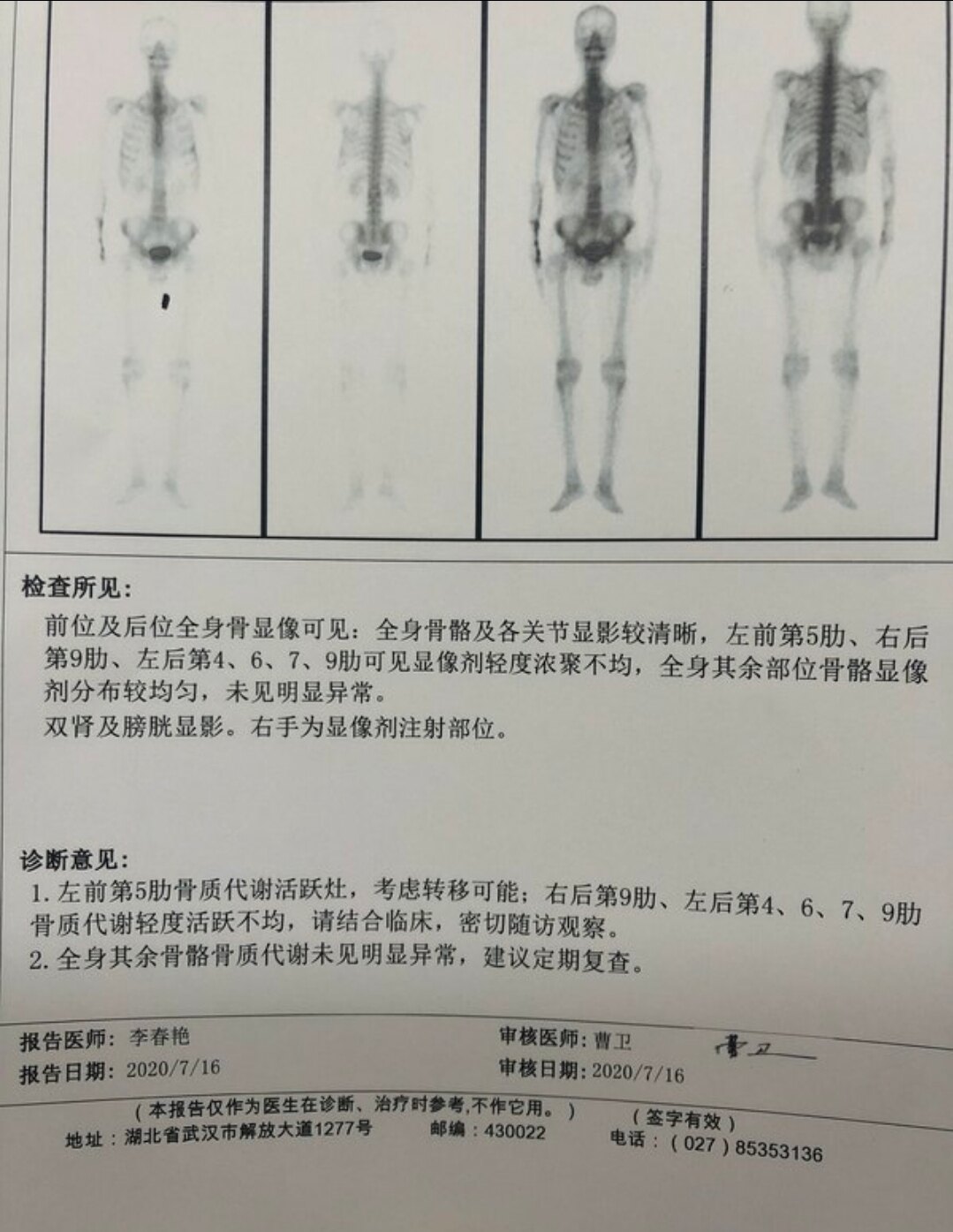 劉懿博士說肺癌一三一〇早期肺癌術後九個月考慮肋骨轉移怎麼排除