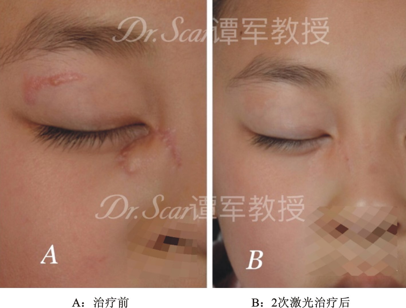 增生性瘢痕的激光-皮肤再生修复(二)_疤痕_疤痕治疗方式 - 好大夫在线