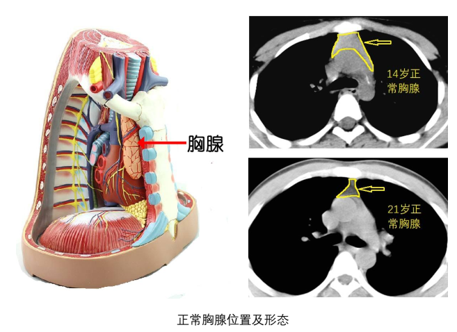 胸腺肿瘤位置图图片