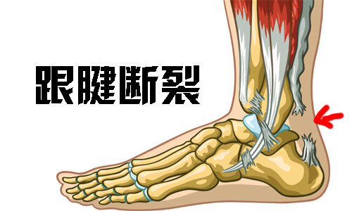 跟腱斷裂引無數英雄競折腰