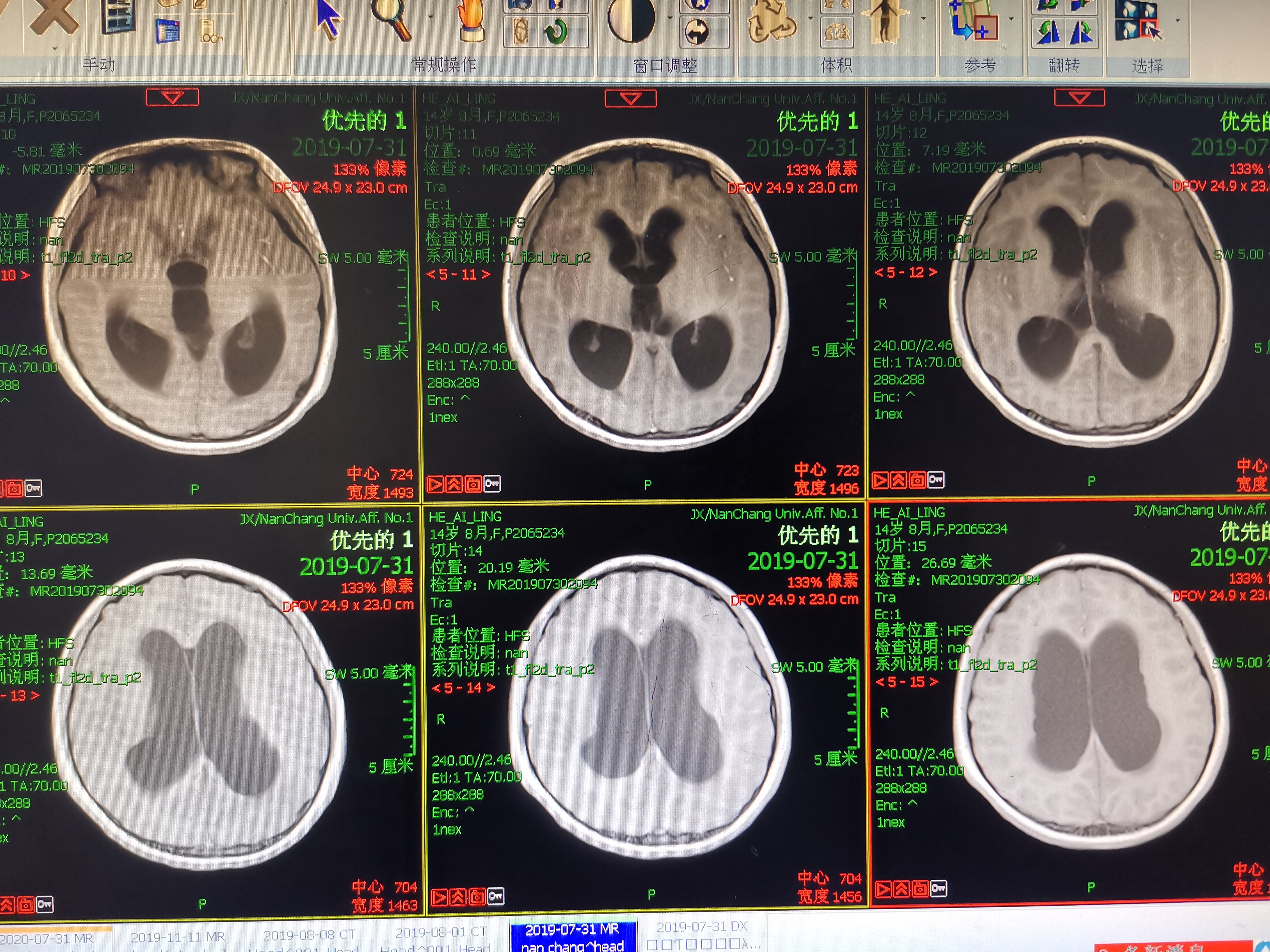 1例脑积水患者的微创个性化治疗 脑室镜第三脑室底造瘘术 脑积水 1例脑积水患者的微创个性化治疗 脑室镜第三脑室底造瘘术 脑积水