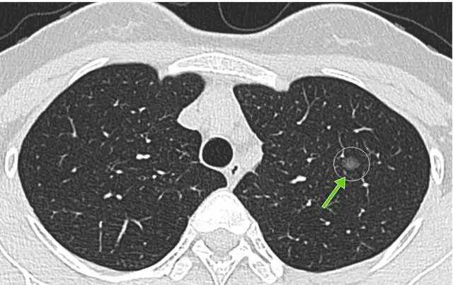 微小结节灶图片
