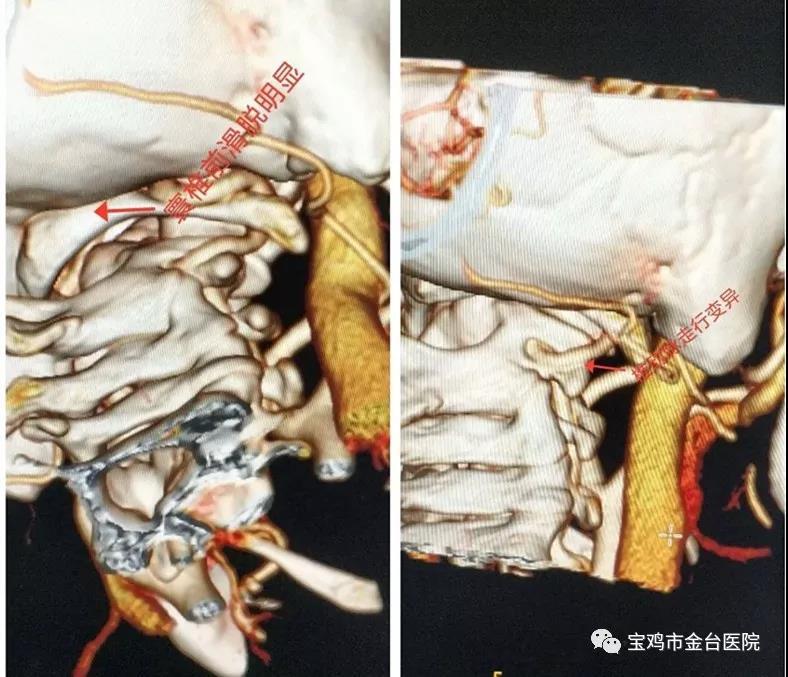 高振輝主任介紹說:寰樞關節脫位,是指頸椎的第一節(寰椎),第二節(樞椎