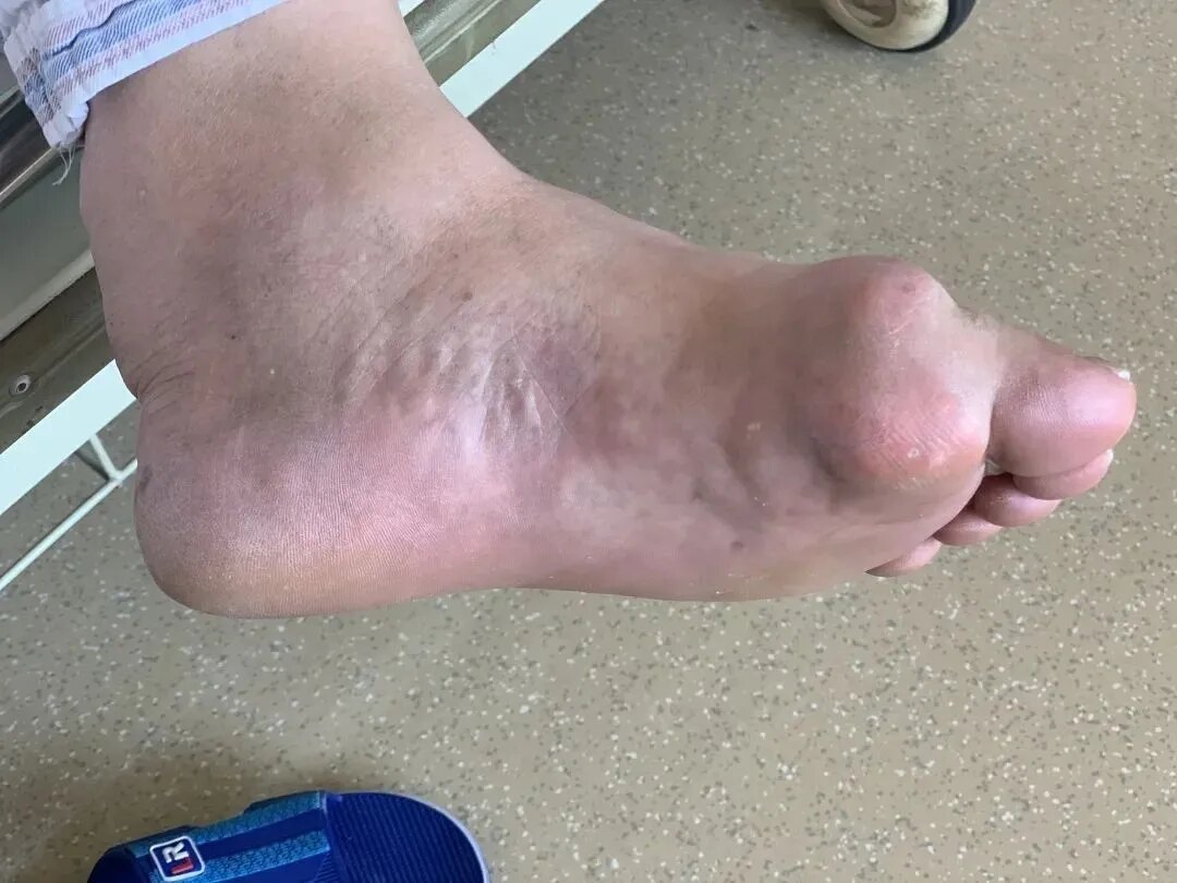 痛风的真相 严格忌口 尿酸为什么不降反升 痛风 痛风 痛风的真相 严格忌口 尿酸为什么不降反升 痛风 痛风