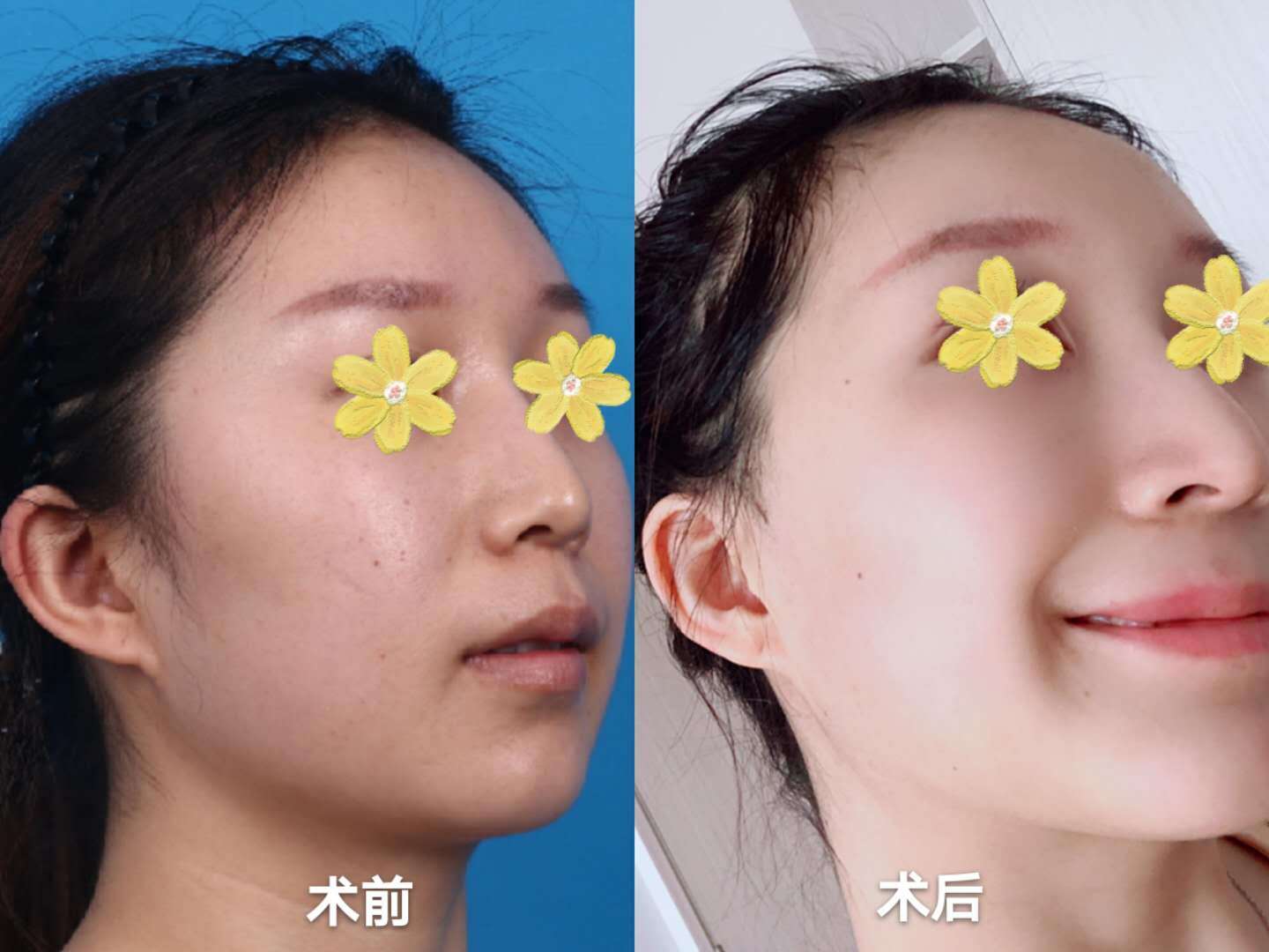 【真实案例分享】张力带固定·颧骨颧弓缩小 下颌角u型截骨 颊脂垫