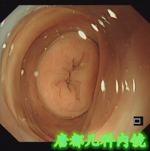退镜观察,回肠末段至回盲瓣5cm肠管显著充血,水肿,回盲瓣水肿超声