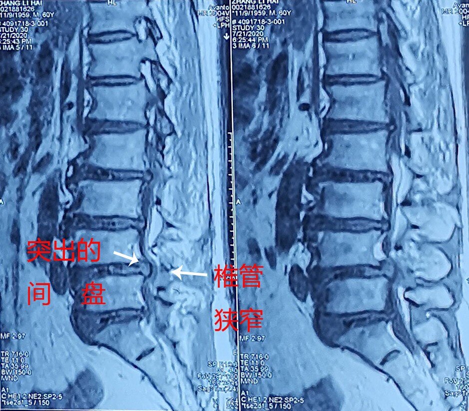 经肌间隙入路微创通道手术治疗腰椎管狭窄和腰间盘突出