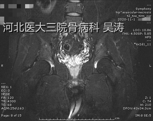 病例二 图三 2020-11-1 图片2.png