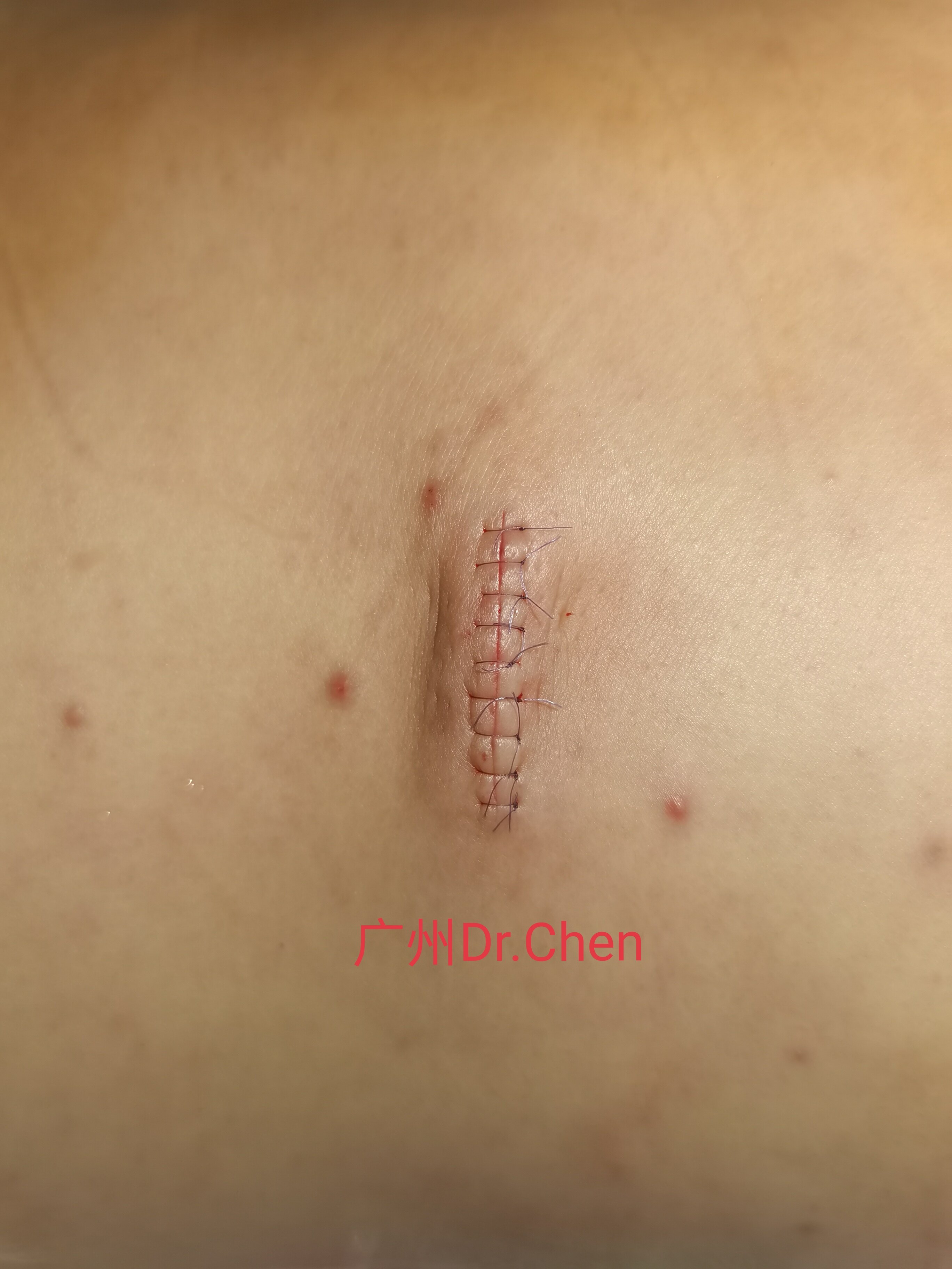 脂肪瘤拆线后的图片图片