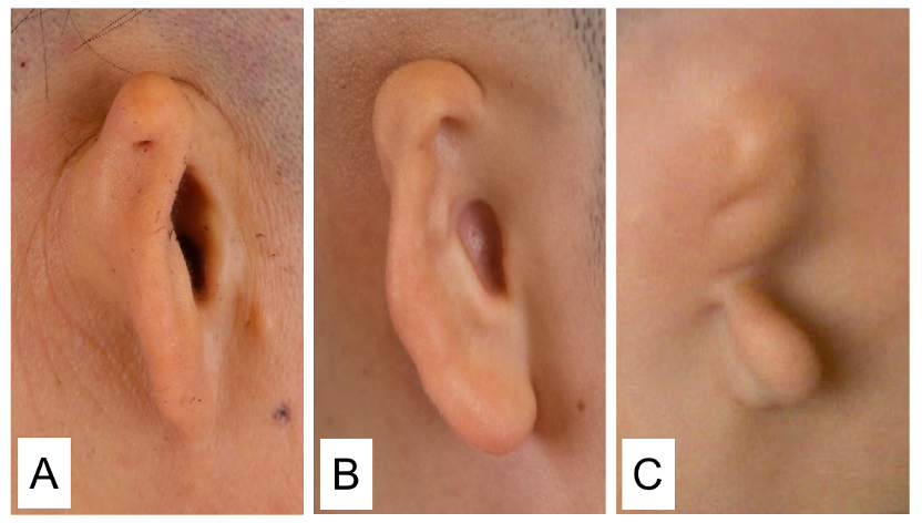 国际共识解读:先天性外中耳畸形及功能性耳再造