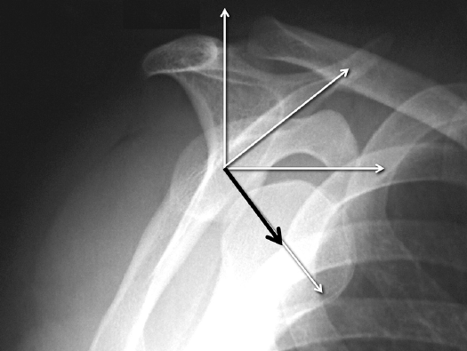 肩关节脱位之肩胛盂骨缺损(骨性 bankart损伤)及评估