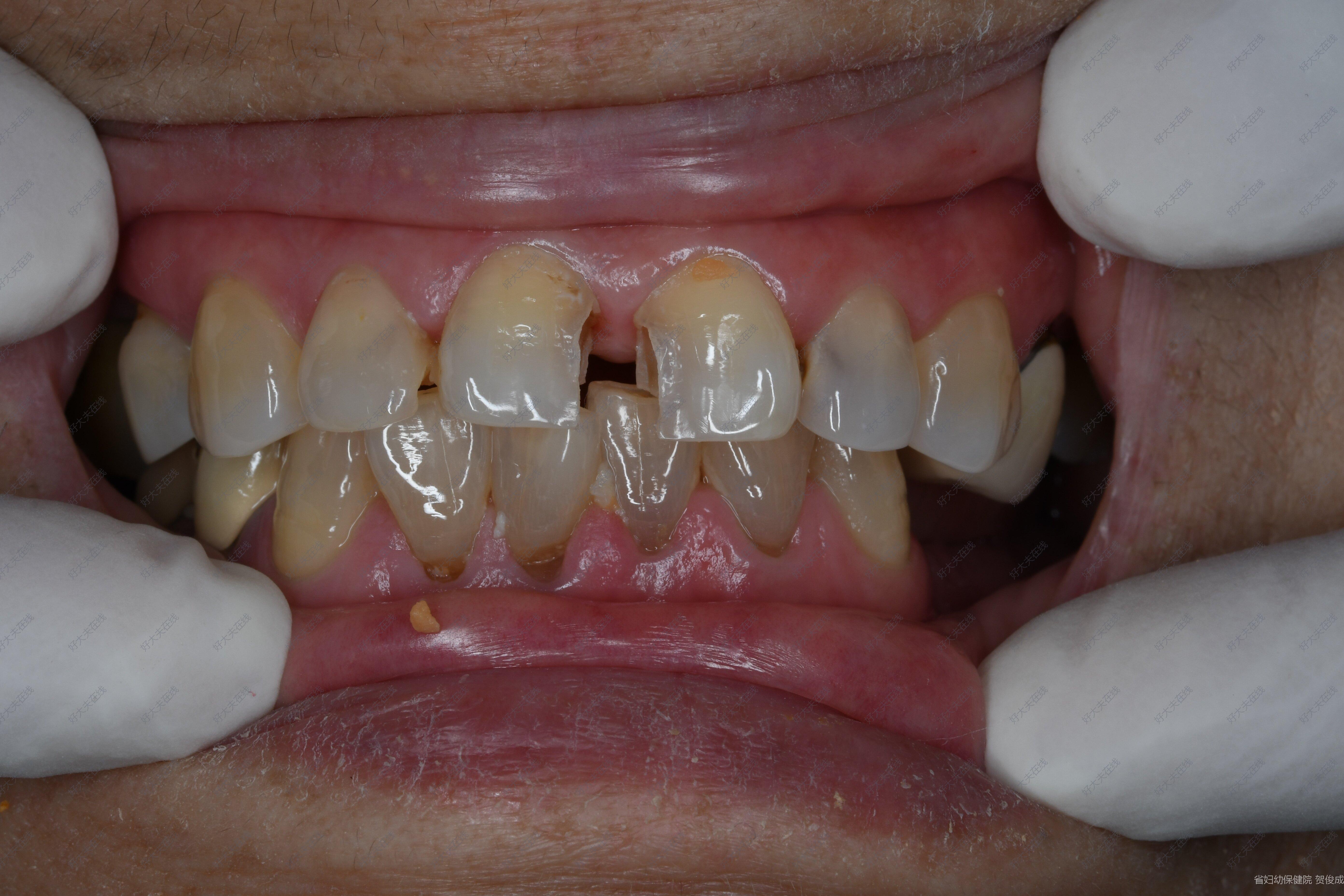 门牙蛀牙修补前后图片图片