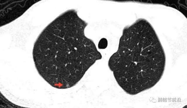5mm的微小实性结节竟是恶性程度最高的肺癌