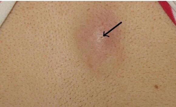 粉瘤 皮脂腺囊肿 皮脂腺囊肿 介绍 症状表现 检查 治疗方式 日常注意事项 好大夫在线 粉瘤 皮脂腺囊肿 皮脂腺囊肿 介绍 症状表现 检查 治疗方式 日常注意事项 好大夫在线