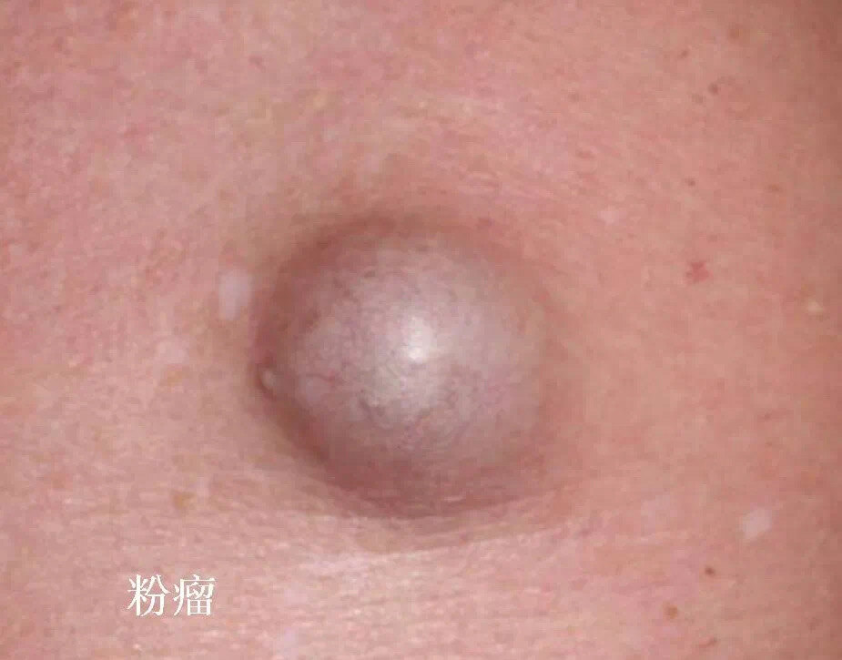 粉瘤皮脂腺囊肿