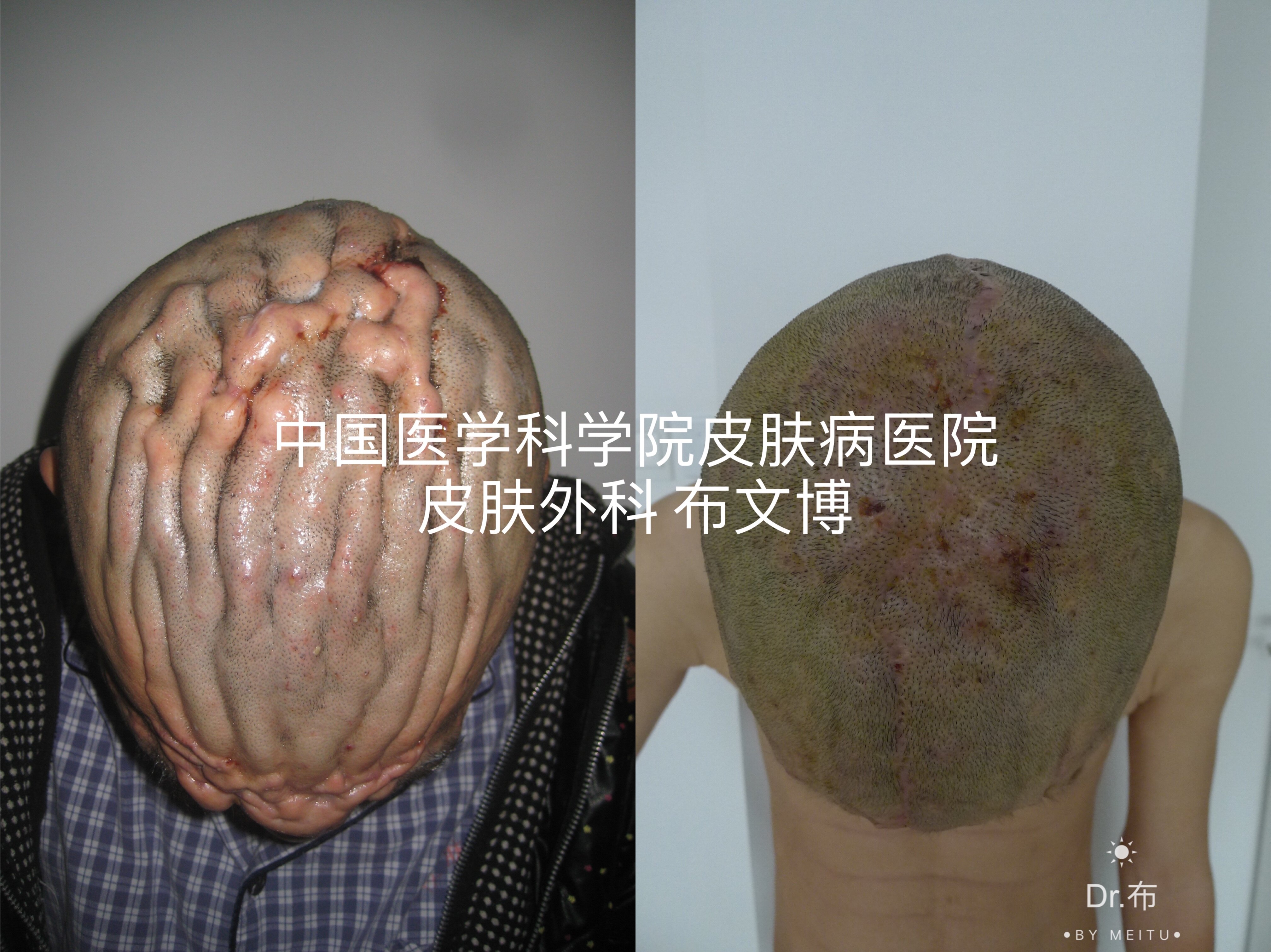化脓性汗腺炎可以治疗 可以治愈 皮肤病 好大夫在线 化脓性汗腺炎可以治疗 可以治愈 皮肤病 好大夫在线