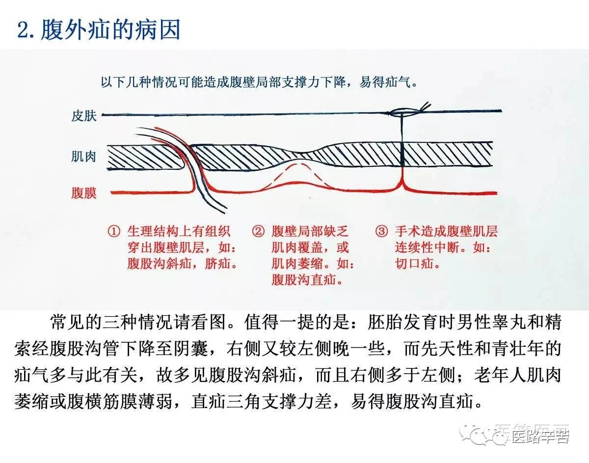 何为"疝气",如何治疗?_腹外疝_介绍_发病原因_治疗方式 - 好大夫在线