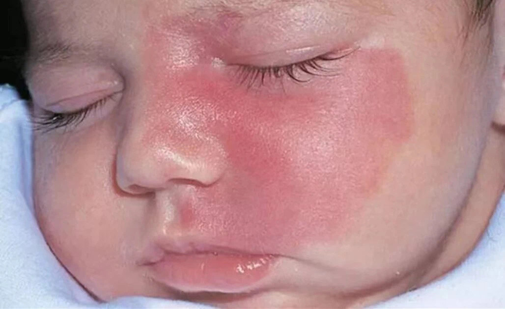 天使宝宝如何处理湿疹和皮肤干燥 鲜红斑痣 鲜红斑痣日常注意事项 好大夫在线