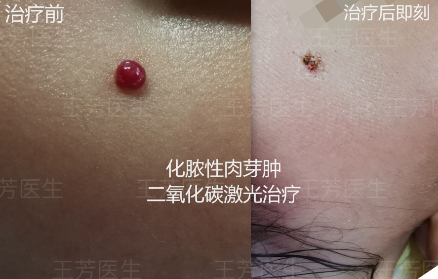 化脓性肉芽肿案例分享 皮肤病 化脓性肉芽肿案例分享 皮肤病