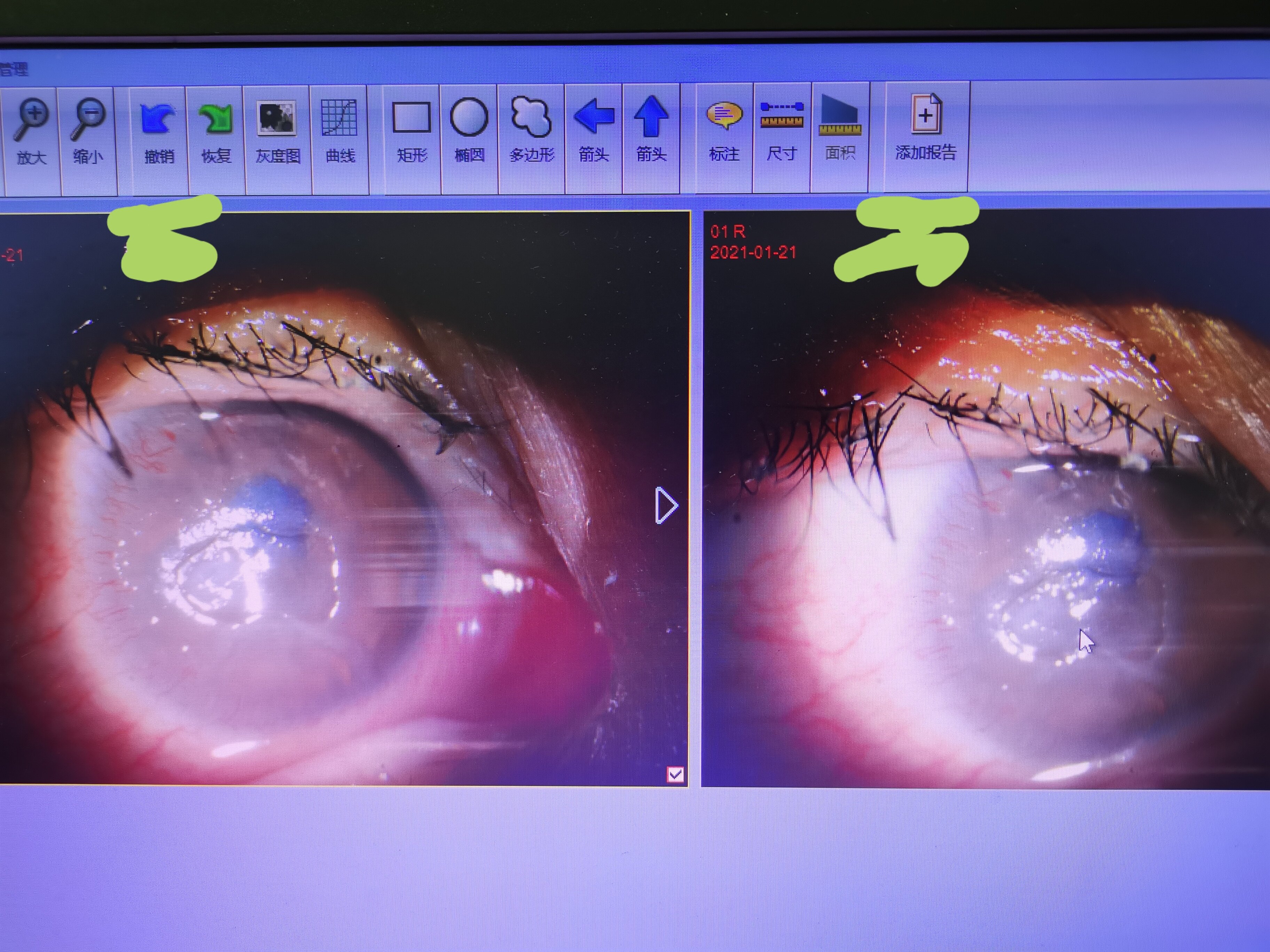 脑干出血之后导致暴露性角膜溃疡. - 好大夫在线