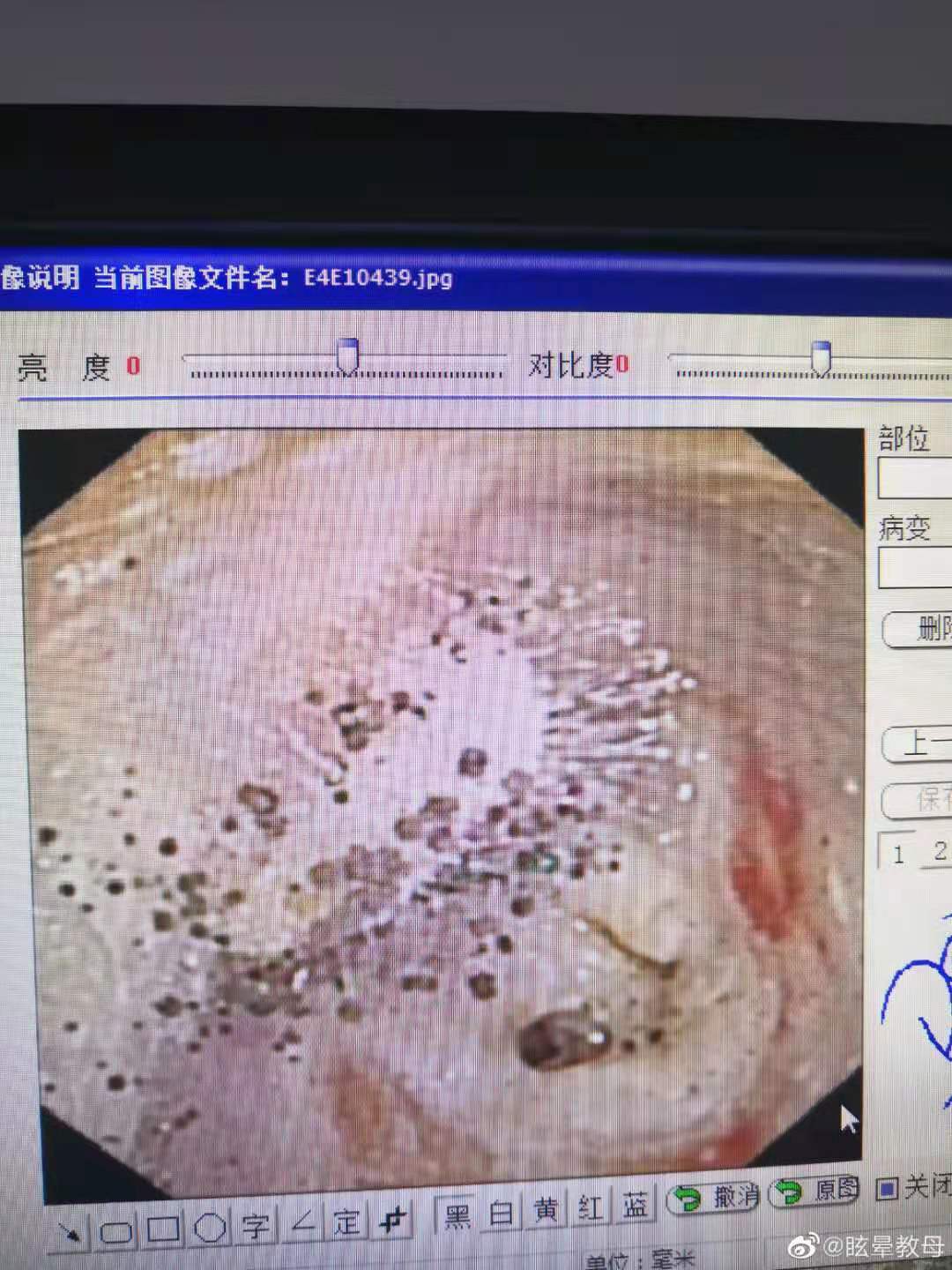 顽固性霉菌性外耳道炎的治疗_外耳道炎_发病原因_症状表现_治疗方式_