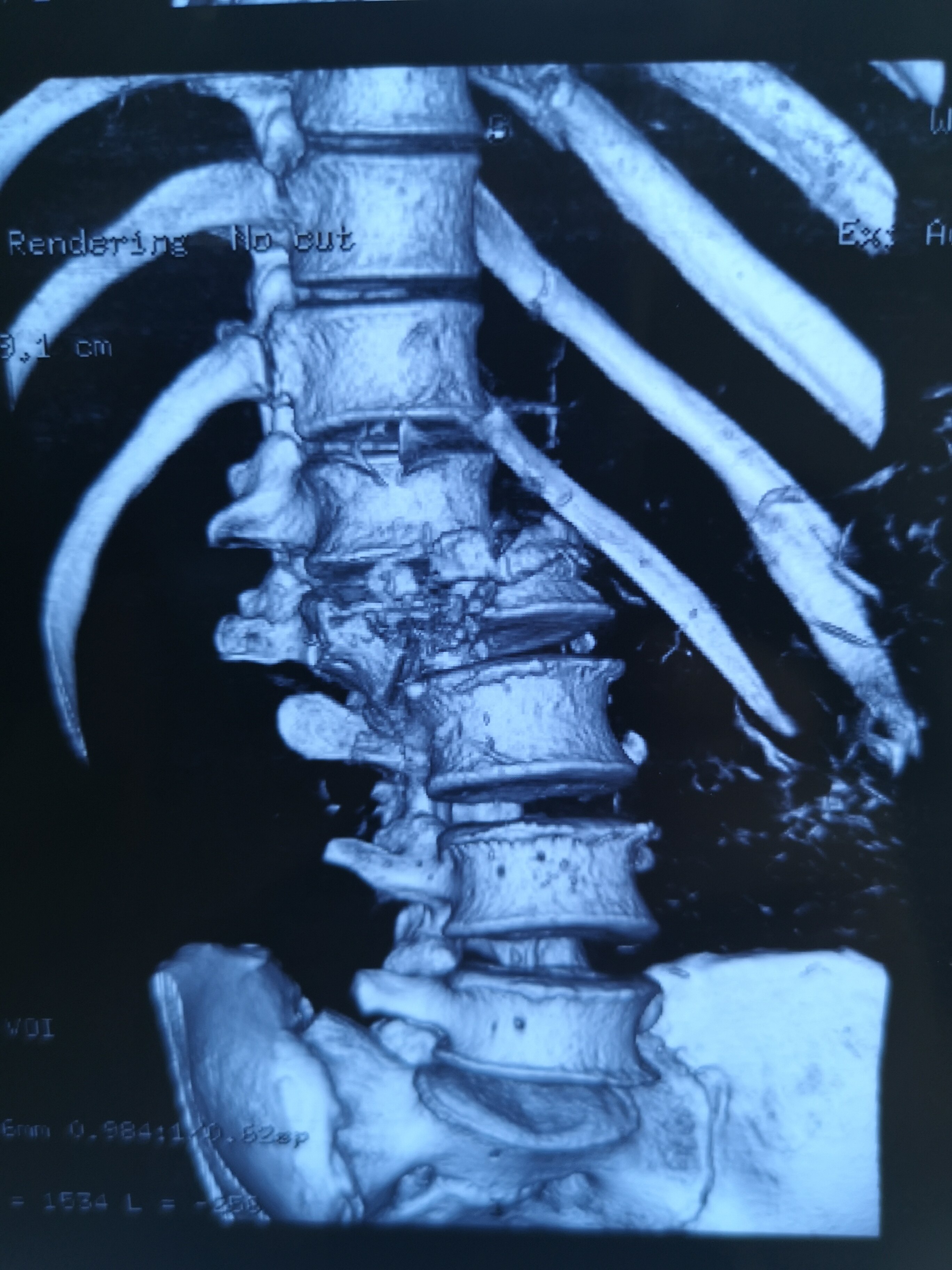 脊柱创伤离断手术 