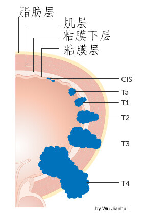 bladder cancer.jpg