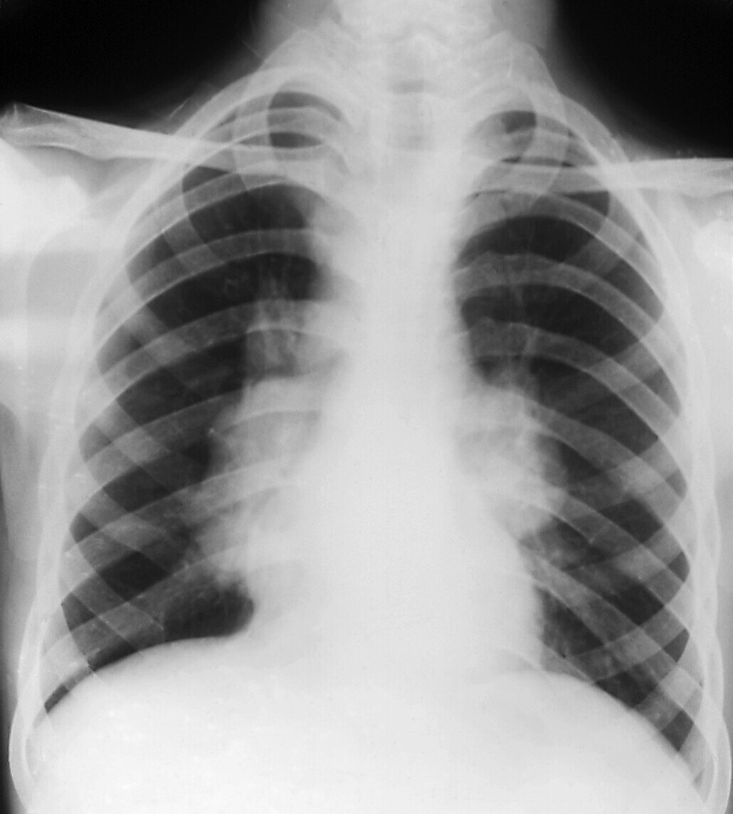 肺结节手术后有哪些后遗症,胸痛呼吸不畅,长期咳嗽,该怎么治疗