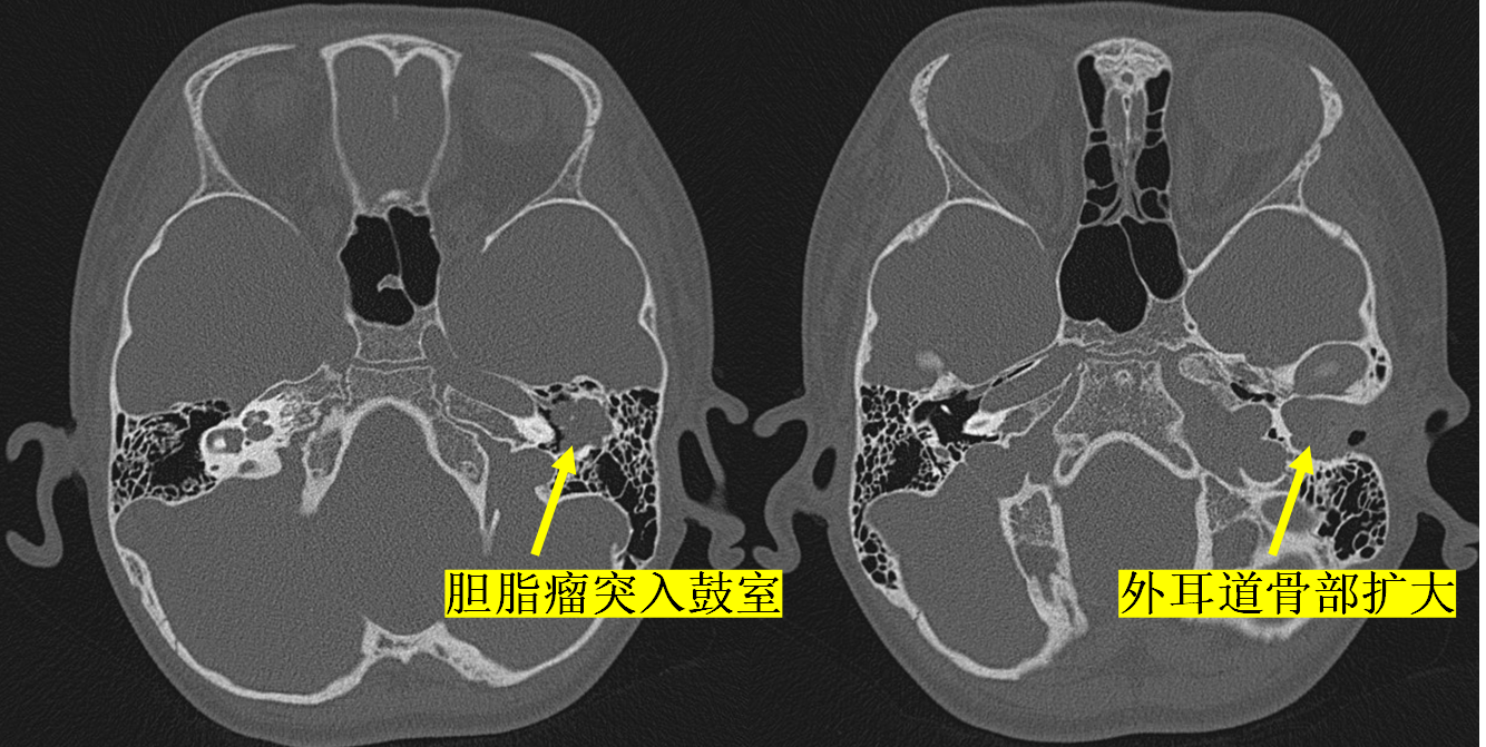 外耳道胆脂瘤图片图片