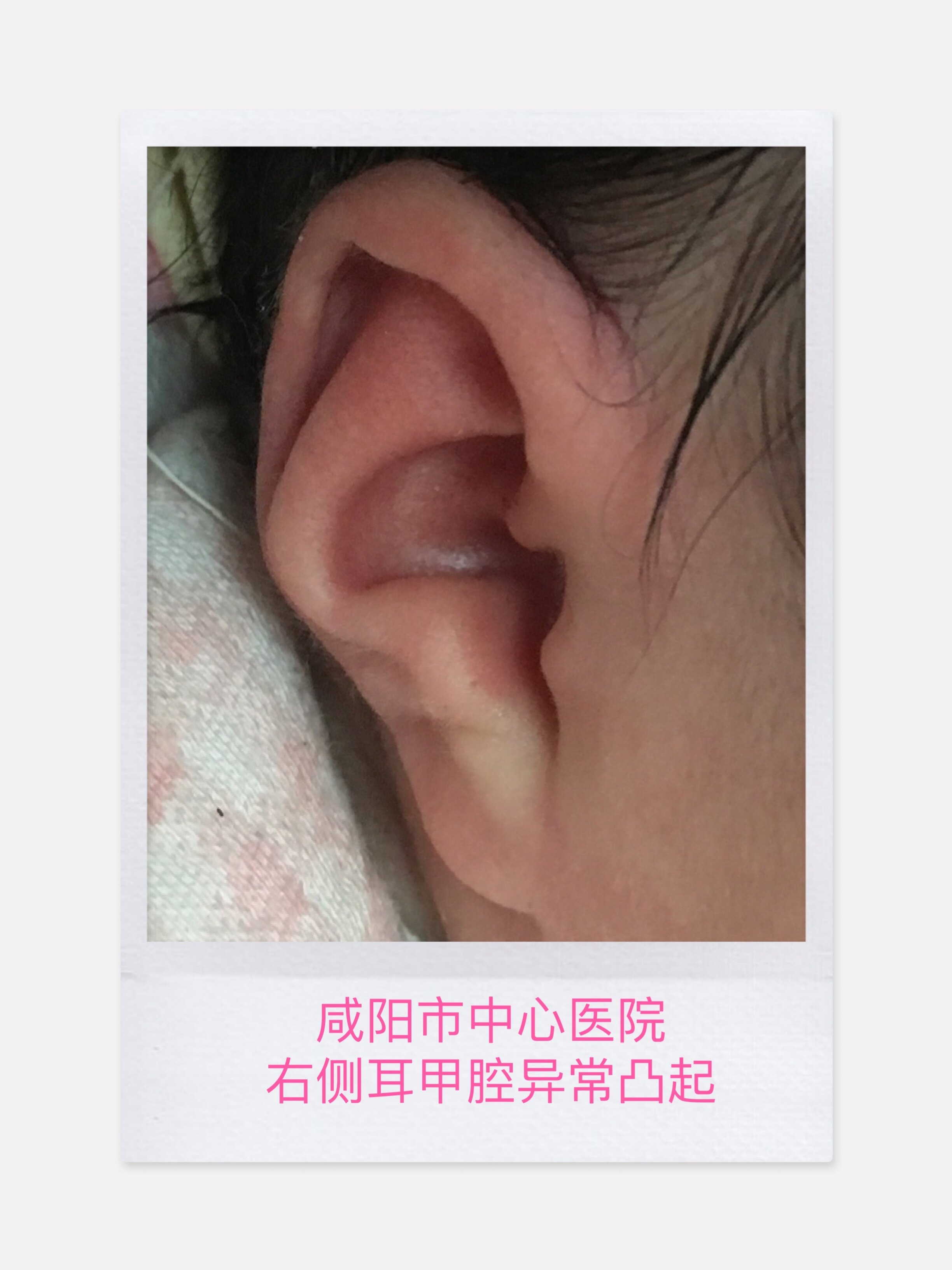 新生儿耳廓畸形科普(一)