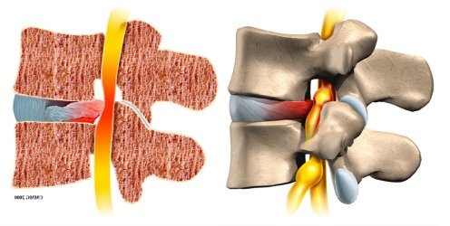 腰椎间盘突出_发病原因_如何预防_治疗方式_日常注意事项 - 好大夫