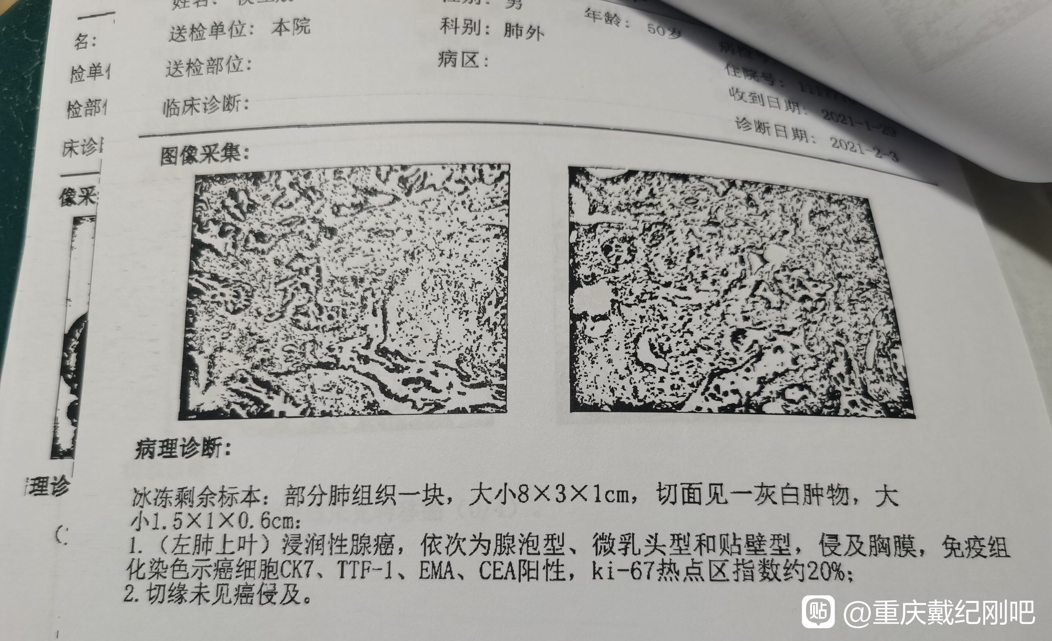 有侵犯胸膜和微乳頭高危因素,建議輔助靶向治療或化療.