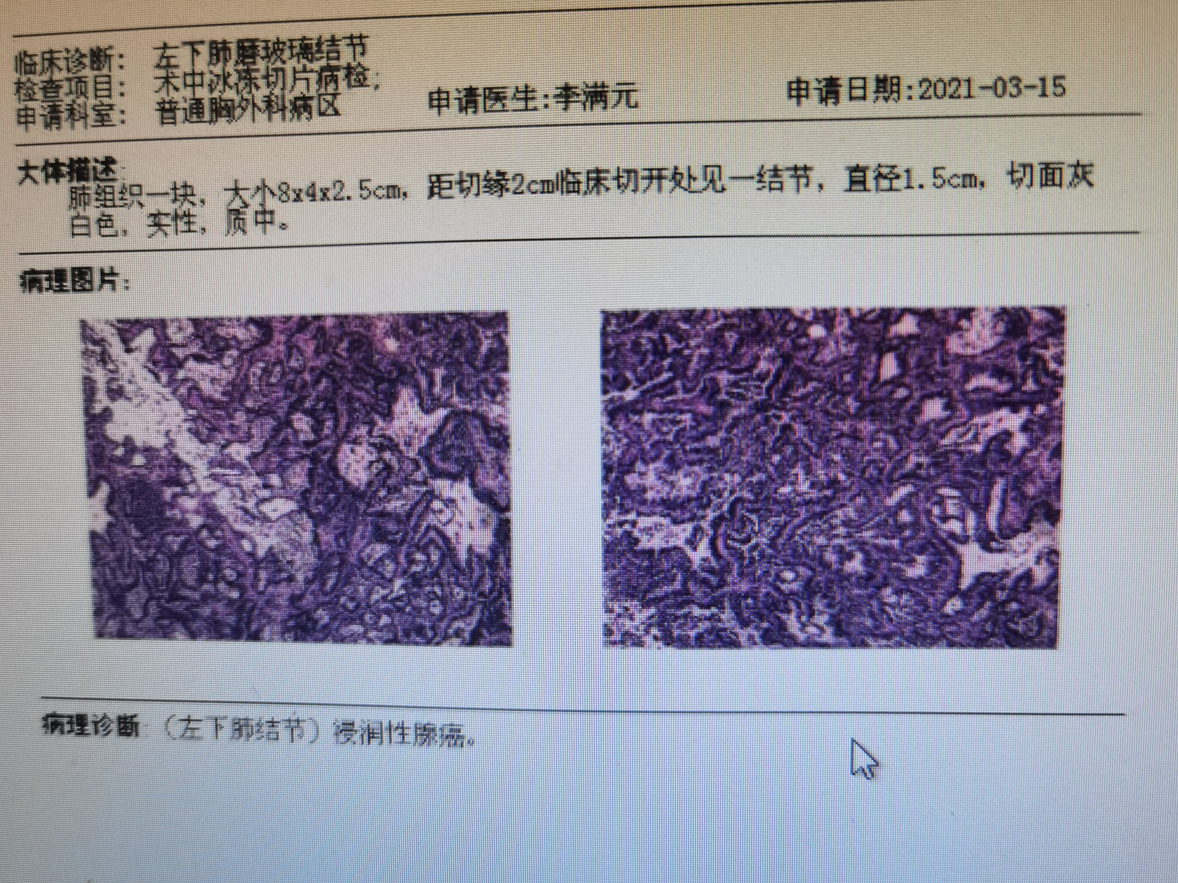 惡之花黏液腺癌一例30歲男性10mm肺實性結節