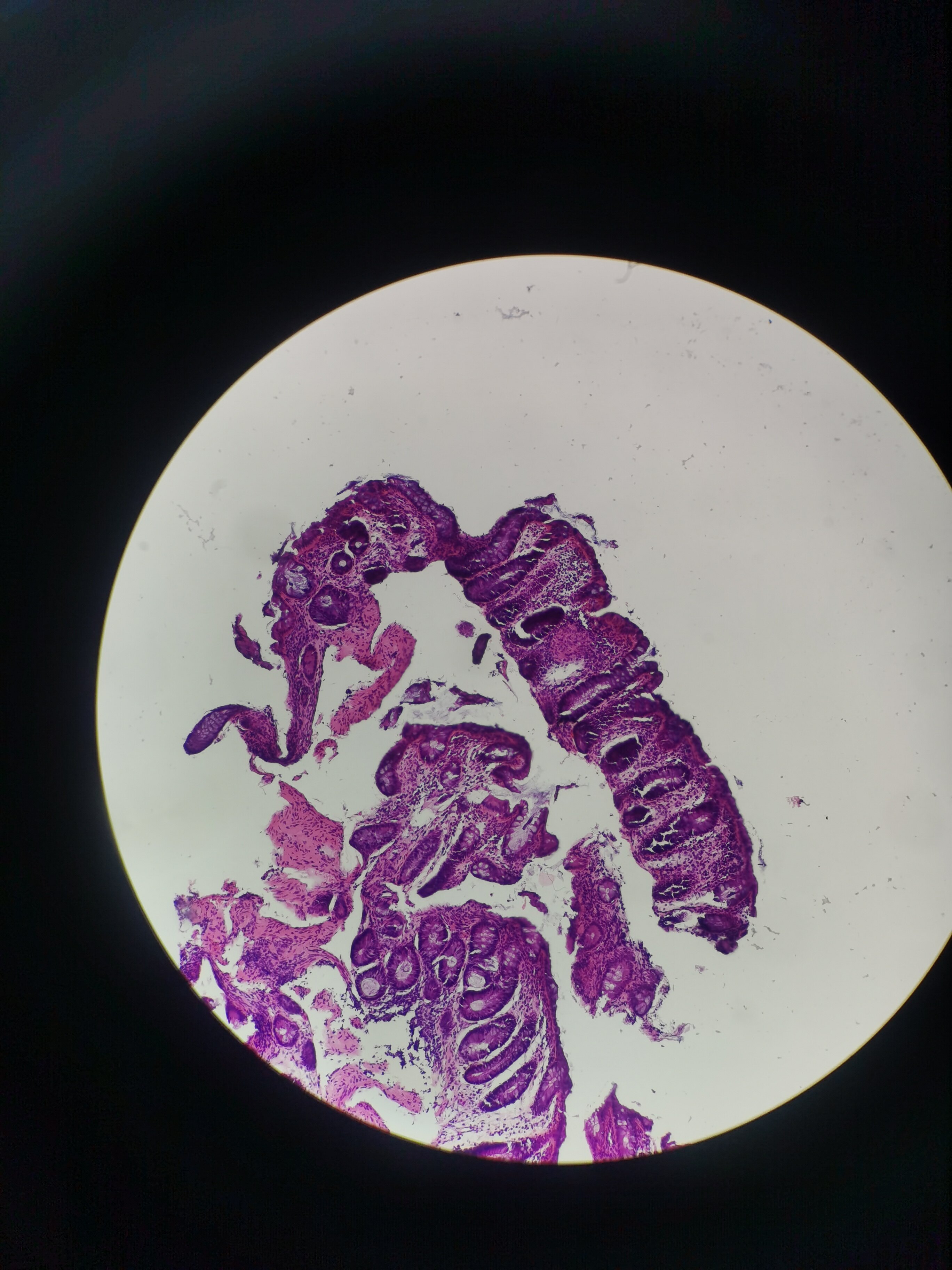 克罗恩病常见肠黏膜固有层上皮样肉芽肿 - 好大夫在线