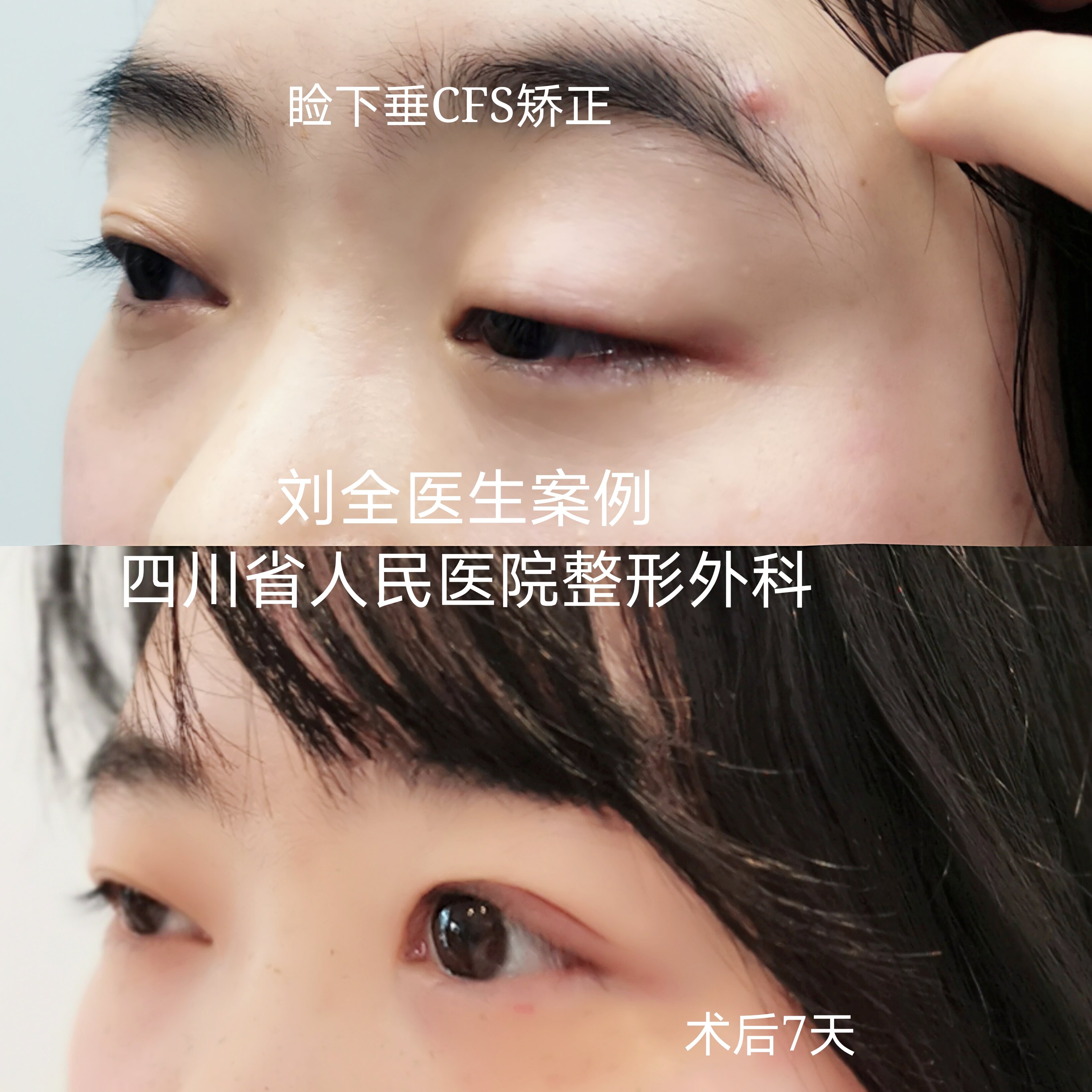 cfs～上睑下垂,用案例说话 - 好大夫在线