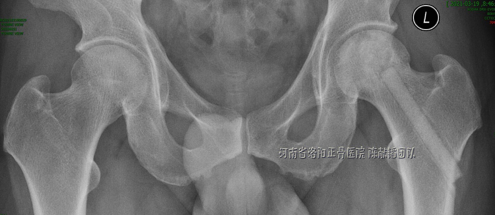 股骨头坏死微创陶瓷棒植入术的最佳适应症