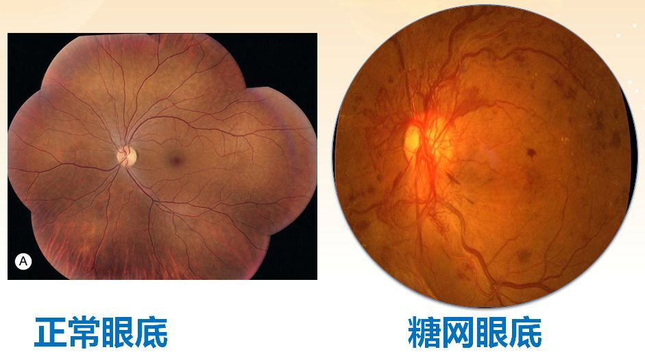 眼底視網膜的血管結構也會被其嚴重破壞,若不加以重視及防控甚至可以