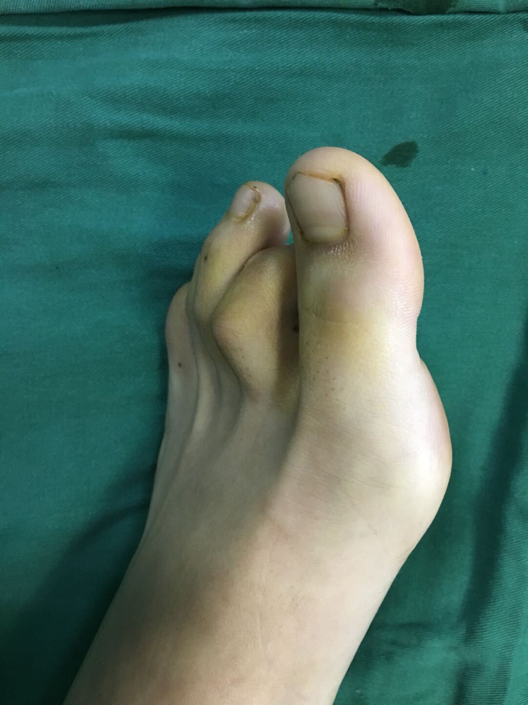 第4个脚趾畸形图片