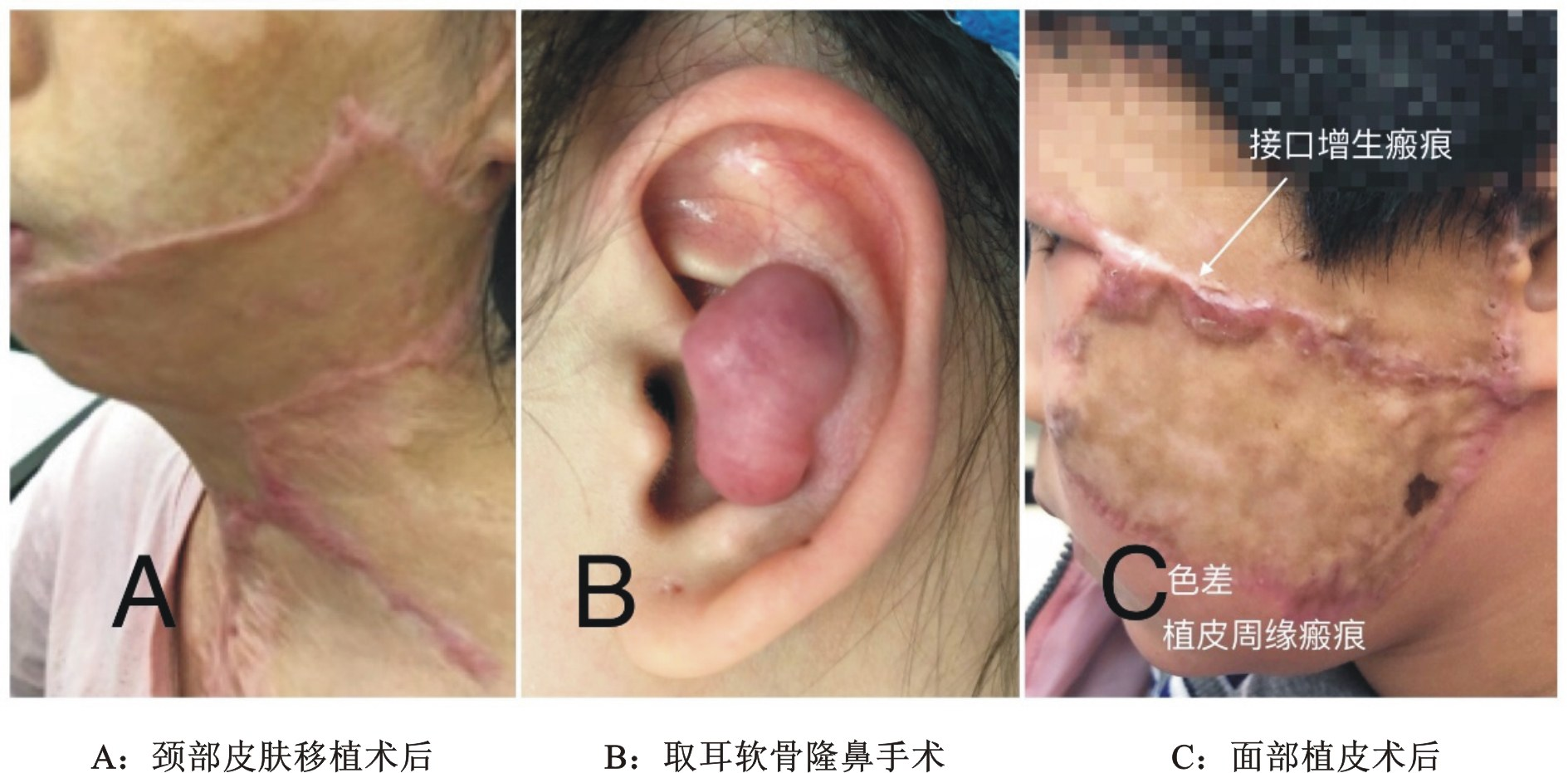 增生性瘢痕的激光-皮膚再生修復(一)_疤痕_治療方式_日常注意事項