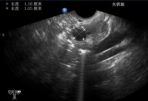 典型案例不开刀治卵巢囊肿超声引导下卵巢囊肿抽液硬化治疗