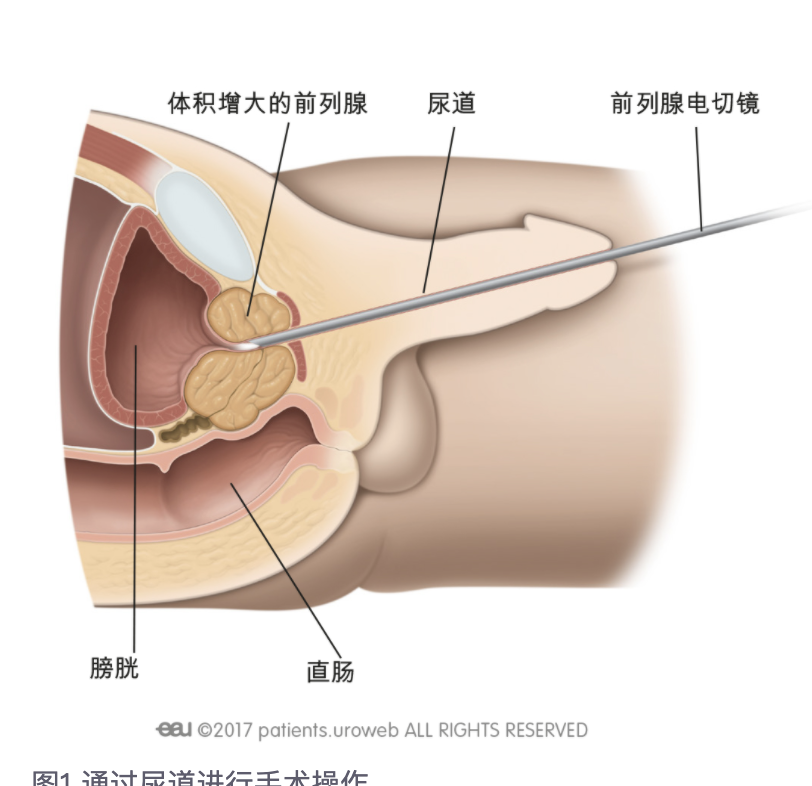 前列腺工作原理图图片