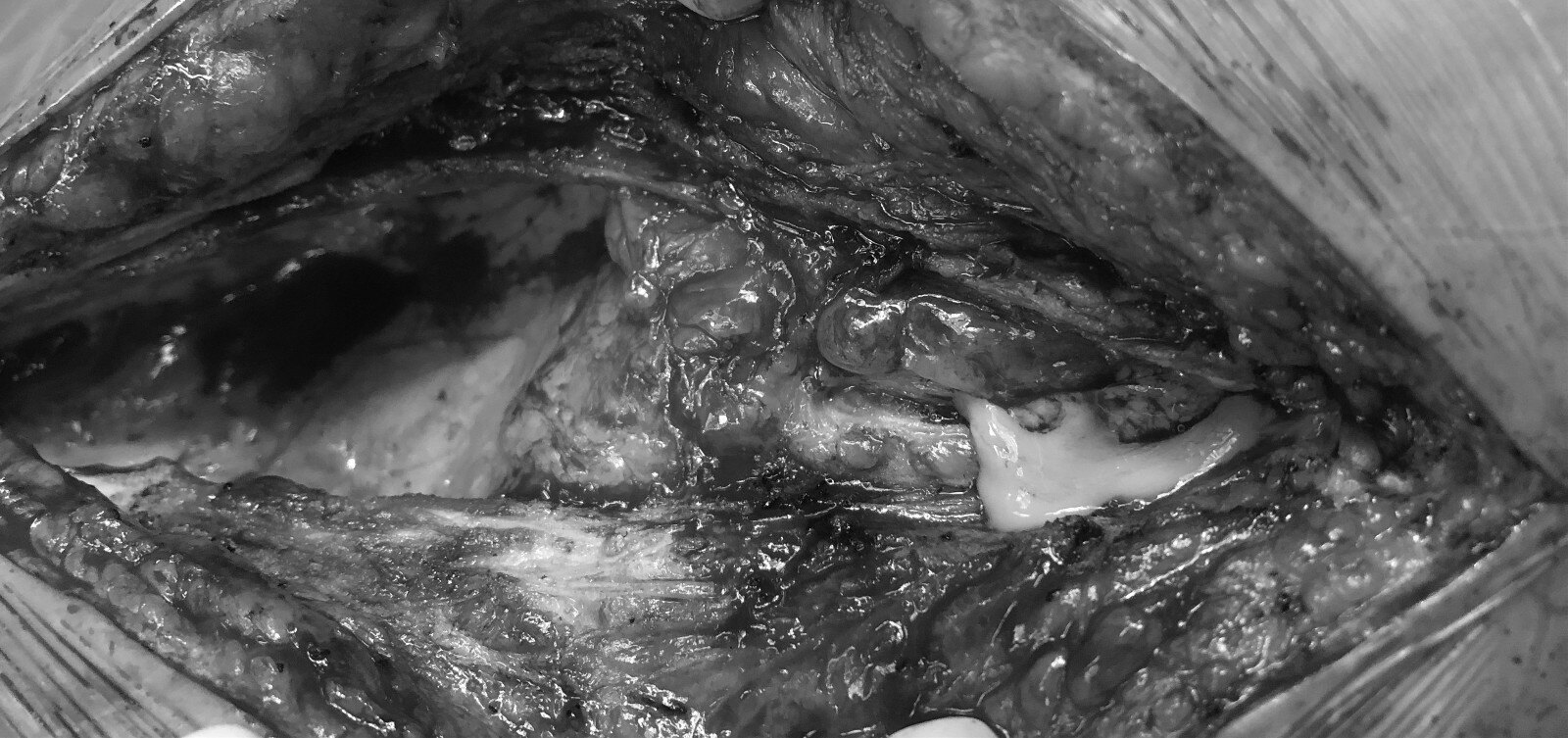 感染梗阻因素导致脓肾的治疗_肾脓肿_肾脓肿治疗方式 - 好大夫在线