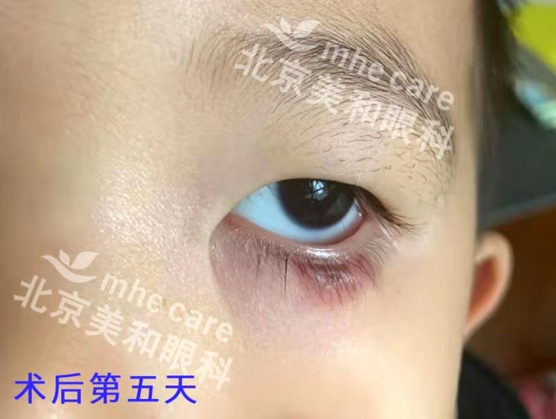 莫把霰粒肿当麦粒肿延误治疗 Eos超脉冲新疗法非手术治疗 霰粒肿 饮食运动 症状