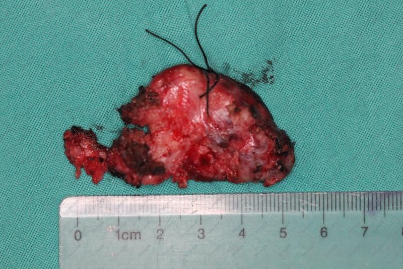 脊柱肿瘤_脊柱肿瘤 - 好大夫在线