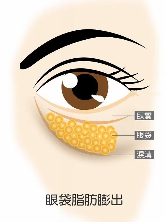 眶隔脂肪释放_去眼袋_去眼袋治疗介绍 - 好大夫在线